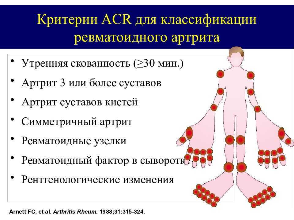 Схема лечения ревматоидного артрита у взрослых