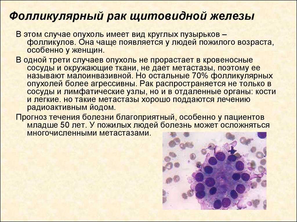 Опухоли щитовидной железы | городская клиническая больница им. ф.и. иноземцева