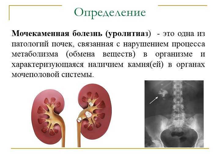 Почечнокаменная болезнь презентация