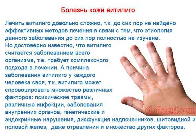 Что такое витилиго. причины, проявления, диагностика и профилактика заболевания.