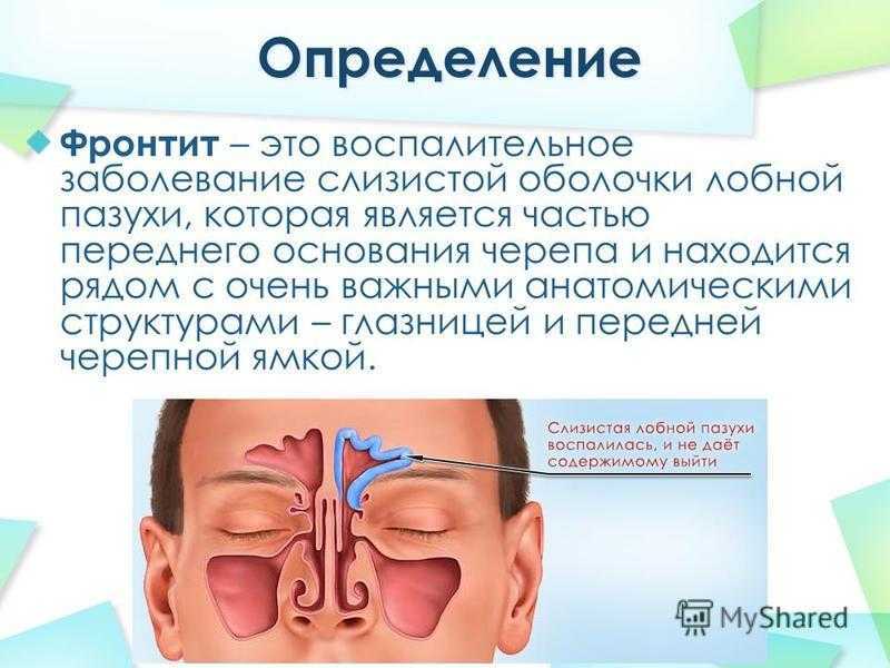 ᐈ что такое фронтит? ~ 【симптомы и лечение】