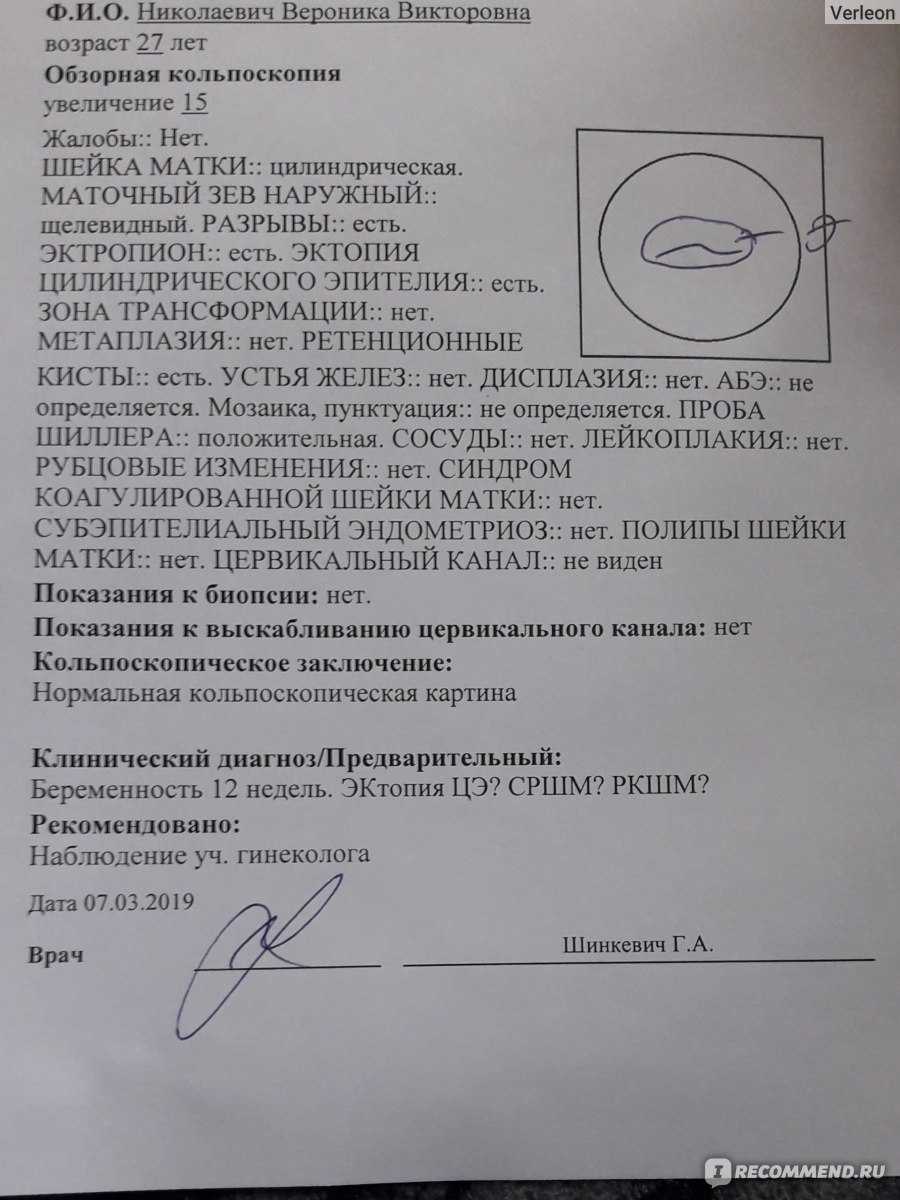 Кольпоскопия шейки матки