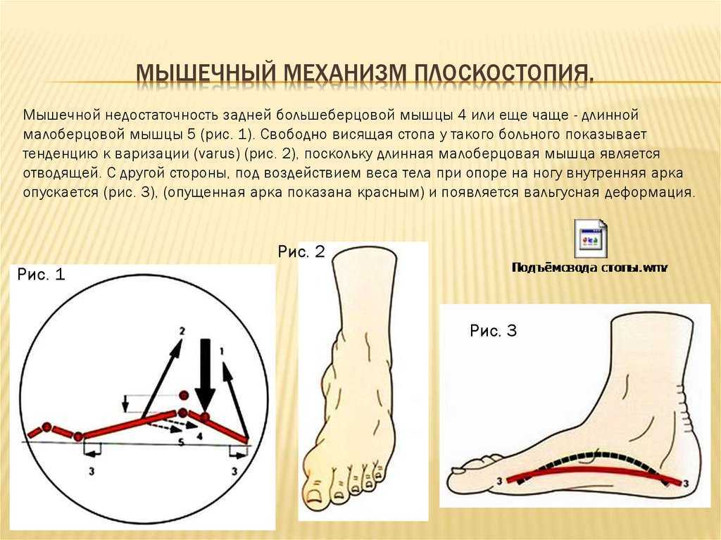 Дисплазия тазобедренных суставов